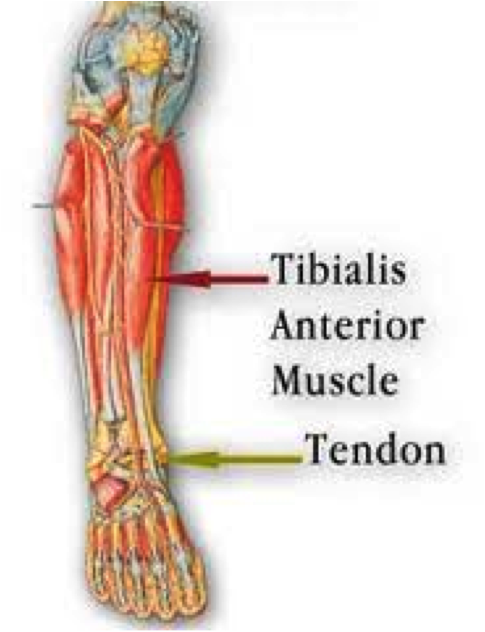 Anterior Tibialis Tendonitis